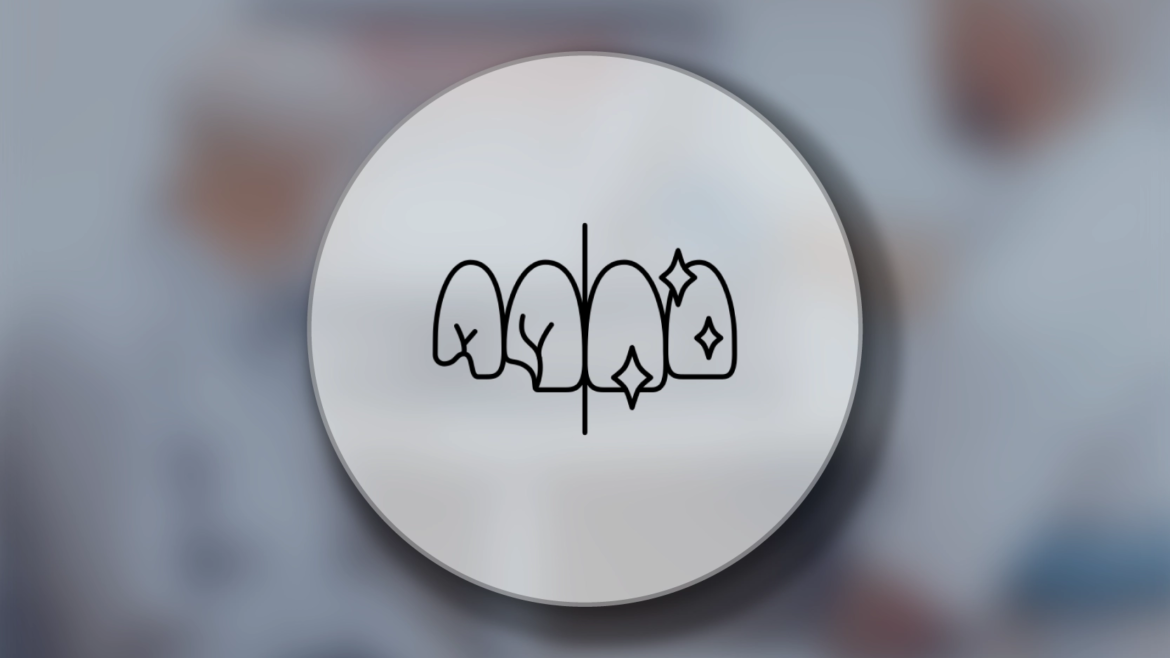 E-Max Kaplama Diş Tedavisi