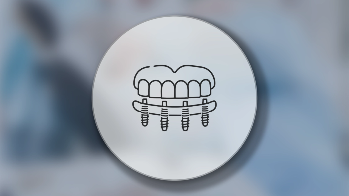 All on Four İmplant Tedavisi Nedir?