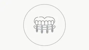 All on Four İmplant Tedavisi Nedir?