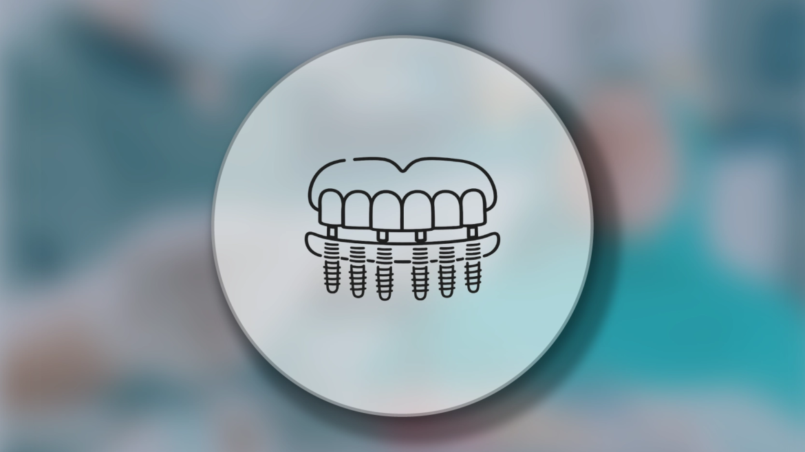 All-on-Six İmplant Tedavisi Nedir?