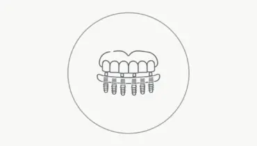 All-on-Six İmplant Tedavisi Nedir?