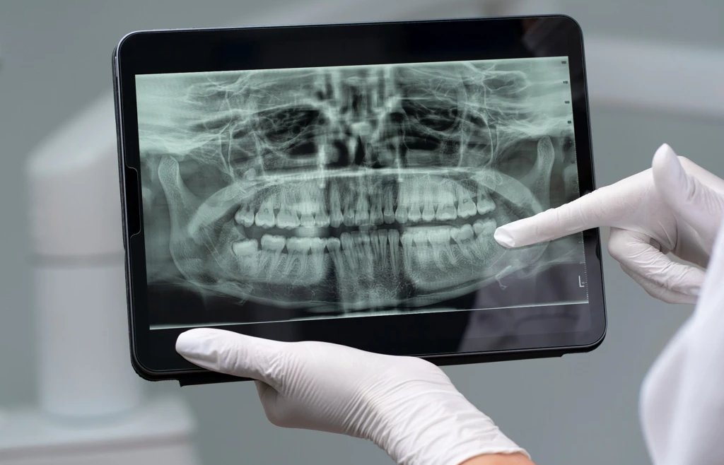 Kayseri Diş Hekimliğinde Röntgen Uygulamaları: Diş Röntgenleri Hakkında Merak Edilenler