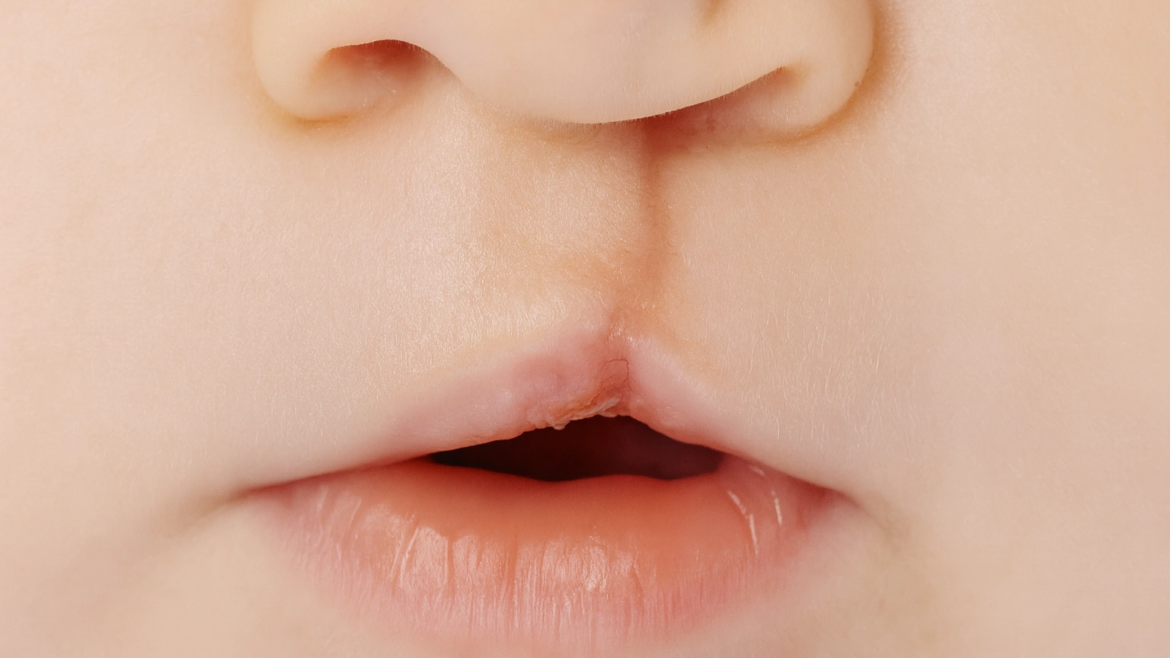 Dudak ve Damak Yarıkları Hakkında Bilmeniz Gerekenler | Kayseri Ağız, Diş ve Çene Cerrahisi