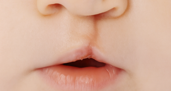 Dudak ve Damak Yarıkları Hakkında Bilmeniz Gerekenler | Kayseri Ağız, Diş ve Çene Cerrahisi