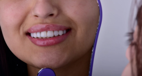 Kayseri Estetik Diş Dolgusu