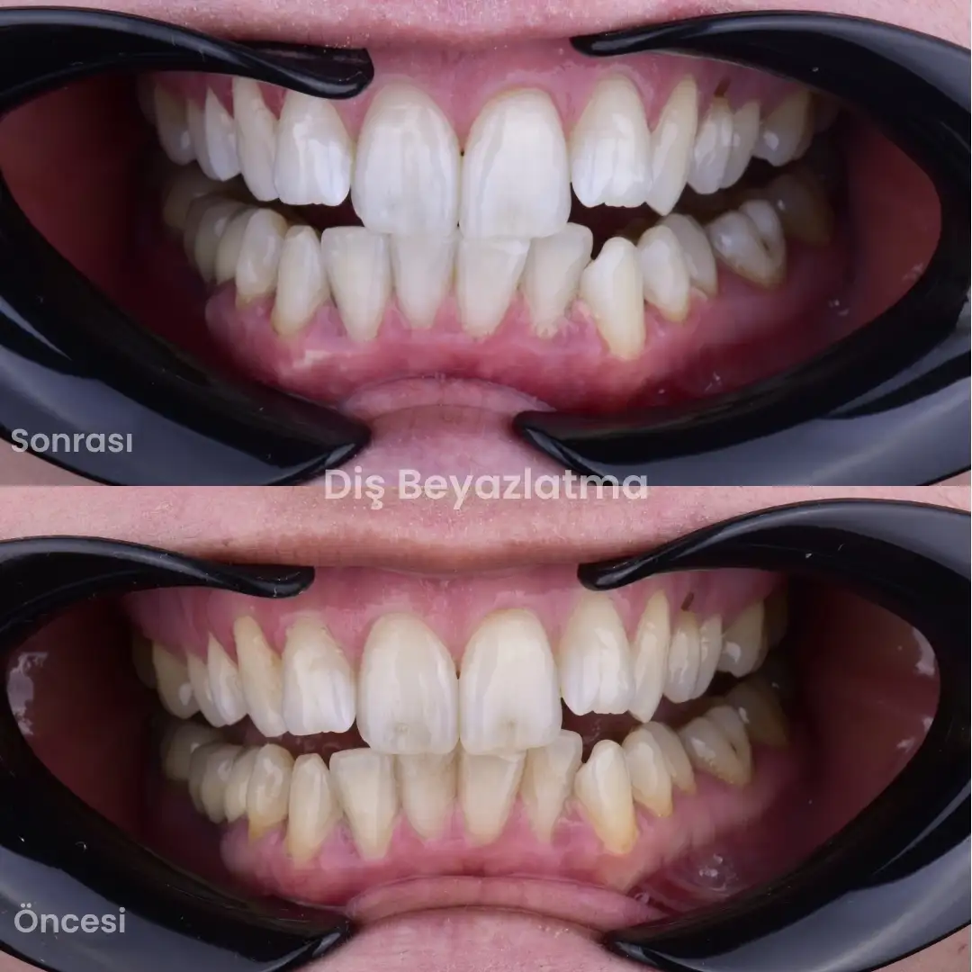 25 (1)