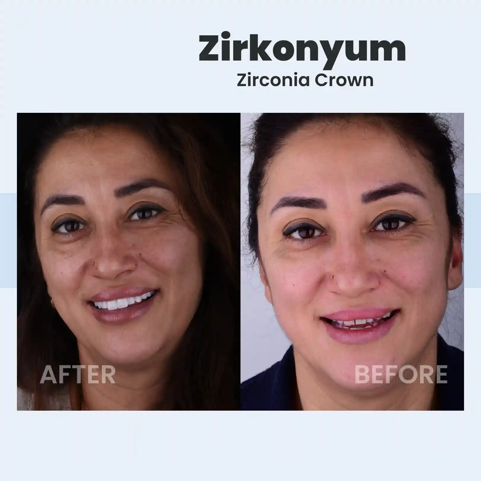 Zirkonyum Kron