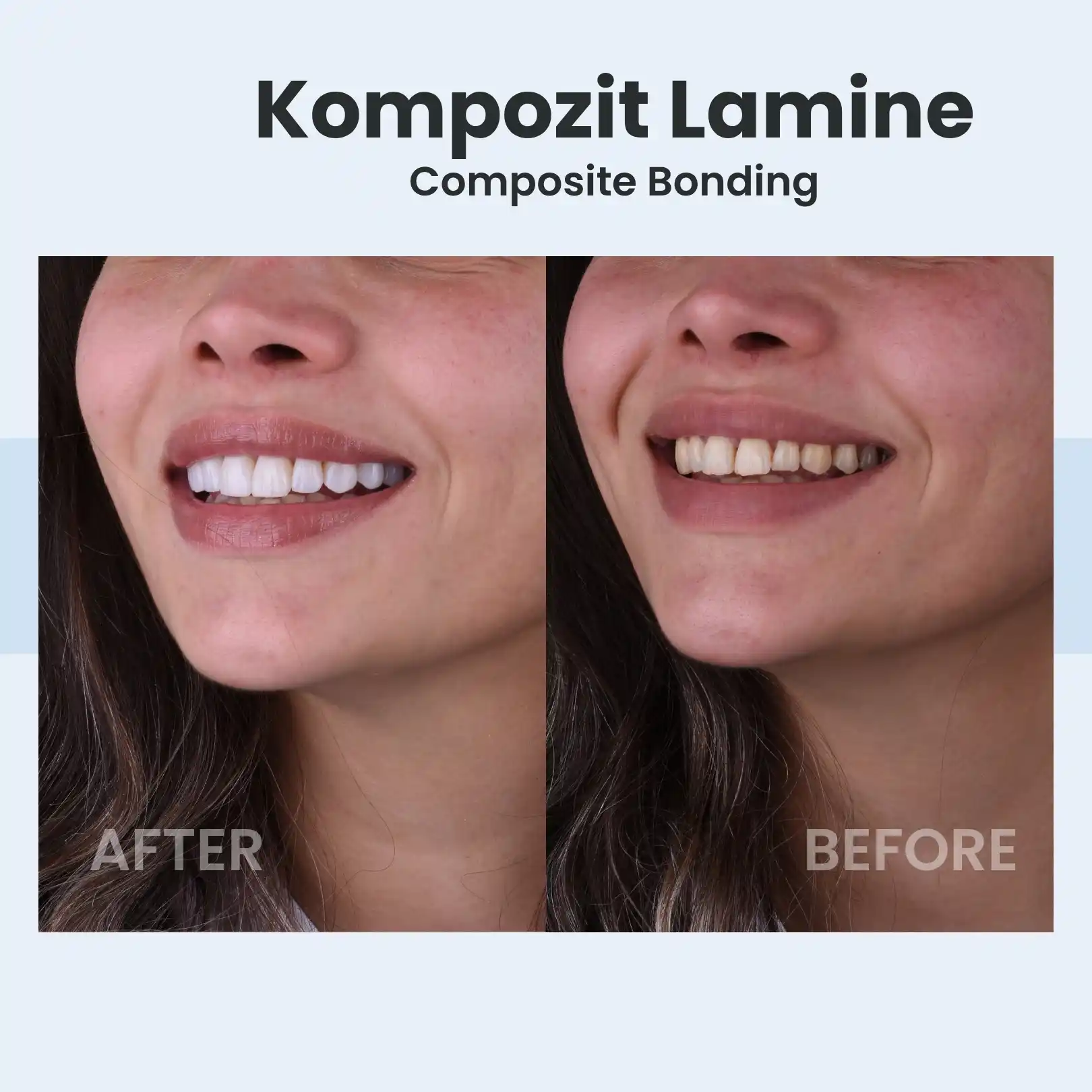 Kompozit Bonding