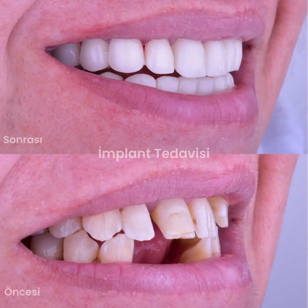 alt implant üzt zirkon